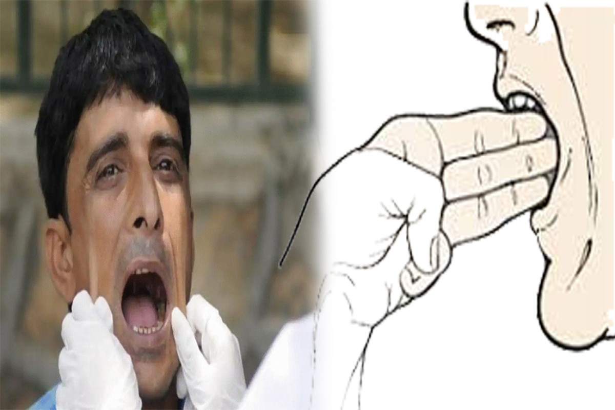 पान, पराग, भोला र गुट्खा लगायत खाएर मुख सानो भएकोे छ ? मुख पहिलेको जस्तै बनाउने ५ टिप्स